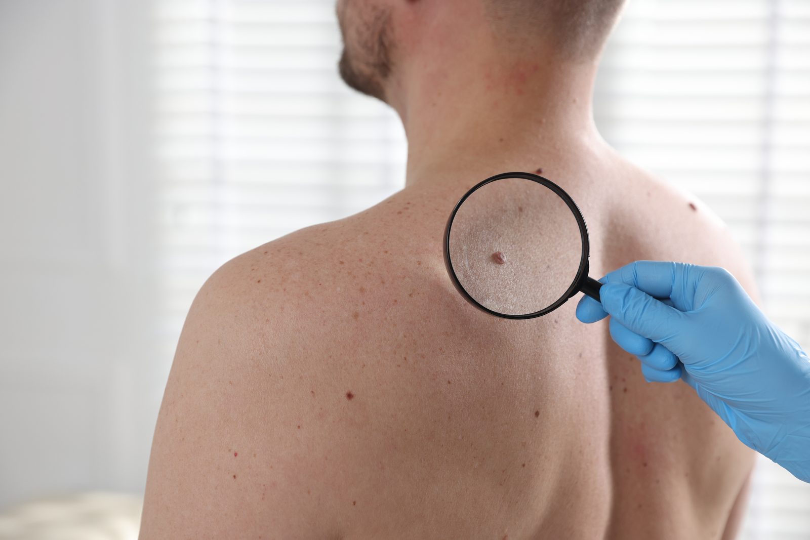 Skin Cancer Checks and Minor Procedures at Toongabbie Doctors Skin Cancer Checks and Minor Procedures at Toongabbie Doctors